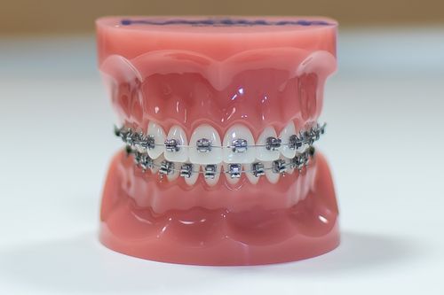 Metal Braces - 3Dental Dublin, Limerick & Galway